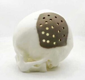 peek 3d print Medical-Implant-1