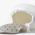 3D Printed Implant Case | IEMAI Helped Bangladesh 3D HUB Successfully Print PEEK Skull Implant