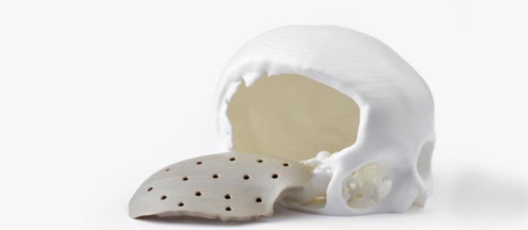 3D Printed Implant Case | IEMAI Helped Bangladesh 3D HUB Successfully Print PEEK Skull Implant