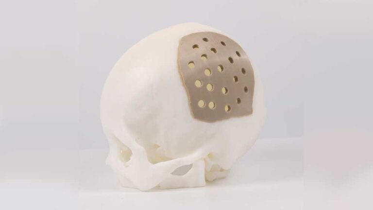 How about a 3d printed medical implant PEEK?